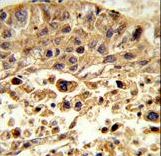 Formalin-fixed and paraffin-embedded human hepatocarcinoma reacted with VPS26A Antibody , which was peroxidase-conjugated to the secondary antibody, followed by DAB staining. This data demonstrates the use of this antibody for immunohistochemistry; clinical relevance has not been evaluated.