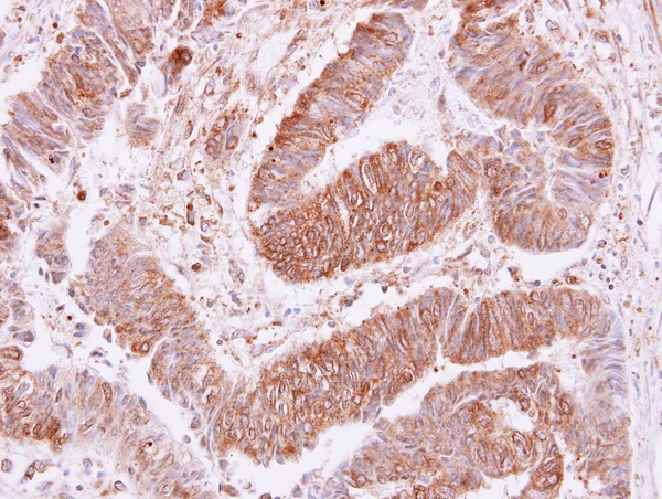 VPS35 antibody [C3], C-term detects VPS35 protein at cytoplasm and membrane on colon carcinoma by immunohistochemical analysis. Sample: Paraffin-embedded colon carcinoma. VPS35 antibody [C3], C-term dilution:1:250.