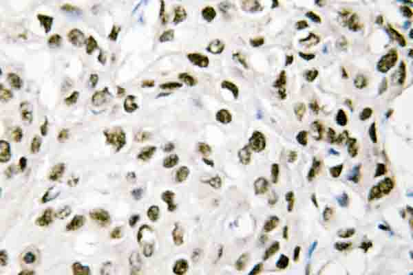 Immunohistochemistry (IHC) analysis of VPS72 (Q149) pAb in paraffin-embedded human breast cancer tissue.