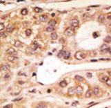 Formalin-fixed and paraffin-embedded human cancer tissue reacted with the primary antibody, which was peroxidase-conjugated to the secondary antibody, followed by AEC staining. This data demonstrates the use of this antibody for immunohistochemistry; clinical relevance has not been evaluated. BC = breast carcinoma; HC = hepatocarcinoma.