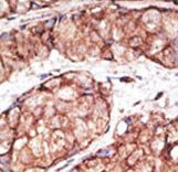 Formalin-fixed and paraffin-embedded human cancer tissue reacted with the primary antibody, which was peroxidase-conjugated to the secondary antibody, followed by AEC staining. This data demonstrates the use of this antibody for immunohistochemistry; clinical relevance has not been evaluated. BC = breast carcinoma; HC = hepatocarcinoma.
