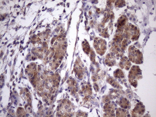IHC of paraffin-embedded Carcinoma of Human pancreas tissue using anti-CHMP5 mouse monoclonal antibody. (Heat-induced epitope retrieval by Tris-EDTA, pH8.0)(1:150).