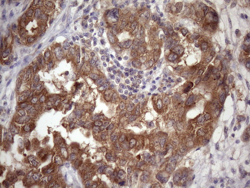 IHC of paraffin-embedded Adenocarcinoma of Human endometrium tissue using anti-CHMP5 mouse monoclonal antibody. (Heat-induced epitope retrieval by Tris-EDTA, pH8.0)(1:150).
