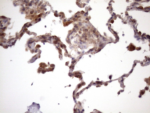 IHC of paraffin-embedded Carcinoma of Human lung tissue using anti-CHMP5 mouse monoclonal antibody. (Heat-induced epitope retrieval by Tris-EDTA, pH8.0)(1:150).
