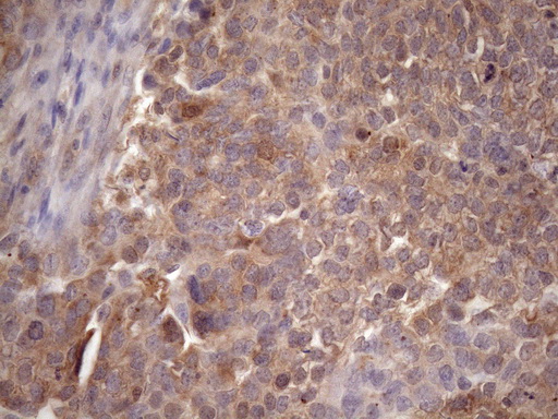 IHC of paraffin-embedded Adenocarcinoma of Human ovary tissue using anti-CHMP5 mouse monoclonal antibody. (Heat-induced epitope retrieval by Tris-EDTA, pH8.0)(1:150).
