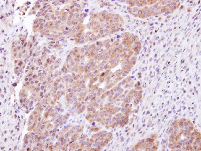 IHC of paraffin-embedded NCIN87 xenograft using CHMP5 antibody at 1:100 dilution.