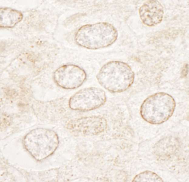 Detection of Human WDFY3 by Immunohistochemistry. Sample: FFPE section of human breast carcinoma. Antibody: Affinity purified rabbit anti-WDFY3 used at a dilution of 1:250.