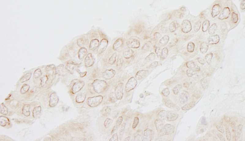 Detection of Human WDFY3 by Immunohistochemistry. Sample: FFPE section of human ovarian carcinoma. Antibody: Affinity purified rabbit anti-WDFY3 used at a dilution of 1:250.