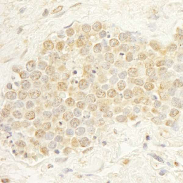 Detection of Human WDR20 by Immunohistochemistry. Sample: FFPE section of human small cell lung cancer. Antibody: Affinity purified rabbit anti-WDR20 used at a dilution of 1:1000 (1 ug/ml). Detection: DAB.