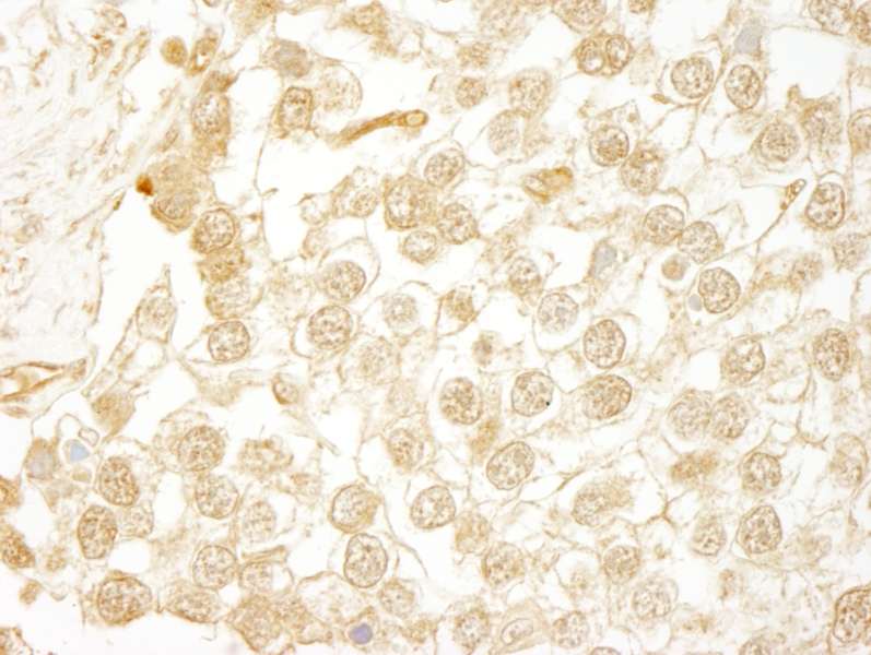Detection of Human WDR20 by Immunohistochemistry. Sample: FFPE section of human seminoma. Antibody: Affinity purified rabbit anti-WDR20 used at a dilution of 1:250.