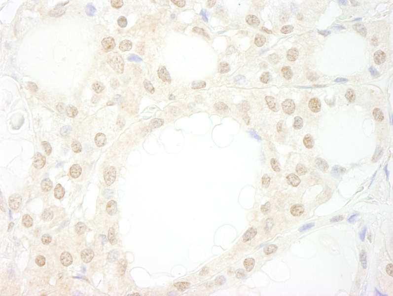 Detection of Human WDR20 by Immunohistochemistry. Sample: FFPE section of human thyroid carcinoma. Antibody: Affinity purified rabbit anti-WDR20 used at a dilution of 1:250.