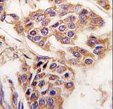 Formalin-fixed and paraffin-embedded human breast carcinoma tissue reacted with C8orf32 antibody , which was peroxidase-conjugated to the secondary antibody, followed by DAB staining. This data demonstrates the use of this antibody for immunohistochemistry; clinical relevance has not been evaluated.