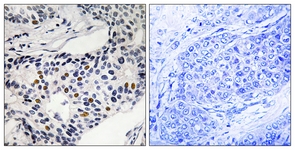 IHC of paraffin-embedded human breast carcinoma, using WEE1 (Phospho-Ser53) Antibody. The sample on the right was incubated with synthetic peptide.