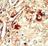 Formalin-fixed and paraffin-embedded human cancer tissue reacted with the primary antibody, which was peroxidase-conjugated to the secondary antibody, followed by AEC staining. This data demonstrates the use of this antibody for immunohistochemistry; clinical relevance has not been evaluated. BC = breast carcinoma; HC = hepatocarcinoma.