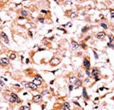 Formalin-fixed and paraffin-embedded human cancer tissue reacted with the primary antibody, which was peroxidase-conjugated to the secondary antibody, followed by AEC staining. This data demonstrates the use of this antibody for immunohistochemistry; clinical relevance has not been evaluated. BC = breast carcinoma; HC = hepatocarcinoma