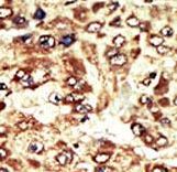 Formalin-fixed and paraffin-embedded human cancer tissue reacted with the primary antibody, which was peroxidase-conjugated to the secondary antibody, followed by AEC staining. This data demonstrates the use of this antibody for immunohistochemistry; clinical relevance has not been evaluated. BC = breast carcinoma; HC = hepatocarcinoma.