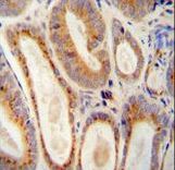 WFDC12 antibody immunohistochemistry of formalin-fixed and paraffin-embedded human prostate carcinoma followed by peroxidase-conjugated secondary antibody and DAB staining.
