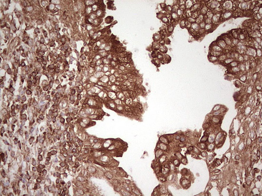 IHC of paraffin-embedded Carcinoma of Human pancreas tissue using anti-WIBG mouse monoclonal antibody. (Heat-induced epitope retrieval by 1 mM EDTA in 10mM Tris, pH8.5, 120°C for 3min).