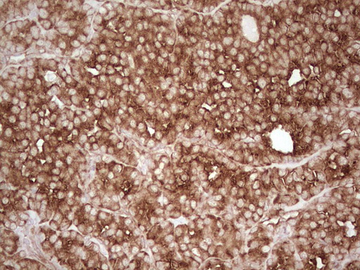 IHC of paraffin-embedded Carcinoma of Human thyroid tissue using anti-WIBG mouse monoclonal antibody. (Heat-induced epitope retrieval by 1 mM EDTA in 10mM Tris, pH8.5, 120°C for 3min).