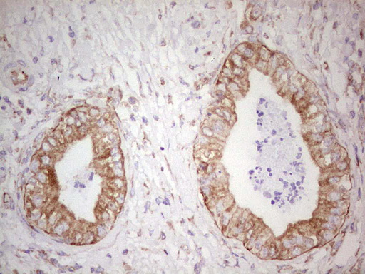 IHC of paraffin-embedded Carcinoma of Human pancreas tissue using anti-WIBG mouse monoclonal antibody. (Heat-induced epitope retrieval by 1 mM EDTA in 10mM Tris, pH8.5, 120°C for 3min).