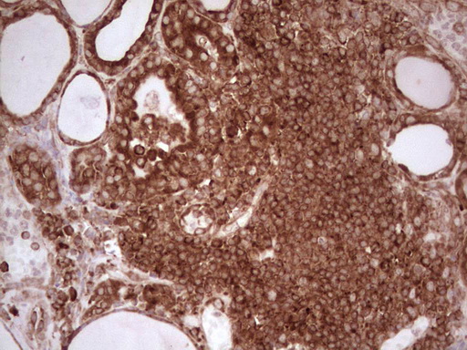 IHC of paraffin-embedded Human thyroid tissue using anti-WIBG mouse monoclonal antibody. (Heat-induced epitope retrieval by 1 mM EDTA in 10mM Tris, pH8.5, 120°C for 3min).