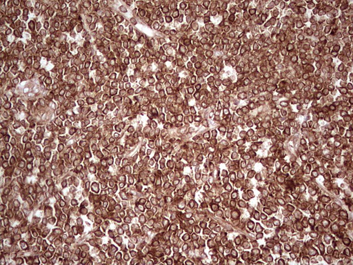 IHC of paraffin-embedded Human lymphoma tissue using anti-WIBG mouse monoclonal antibody. (Heat-induced epitope retrieval by 1 mM EDTA in 10mM Tris, pH8.5, 120°C for 3min).