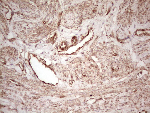 IHC of paraffin-embedded Adenocarcinoma of Human endometrium tissue using anti-WIBG mouse monoclonal antibody. (Heat-induced epitope retrieval by 1 mM EDTA in 10mM Tris, pH8.5, 120°C for 3min).