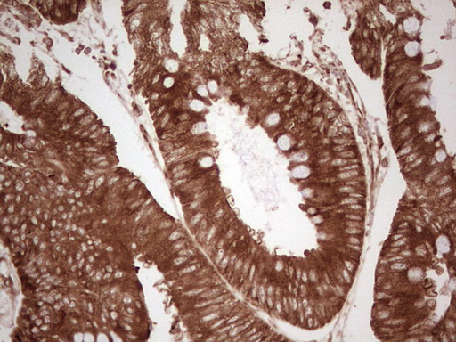IHC of paraffin-embedded Adenocarcinoma of Human colon tissue using anti-WIBG mouse monoclonal antibody. (Heat-induced epitope retrieval by 1 mM EDTA in 10mM Tris, pH8.5, 120°C for 3min).