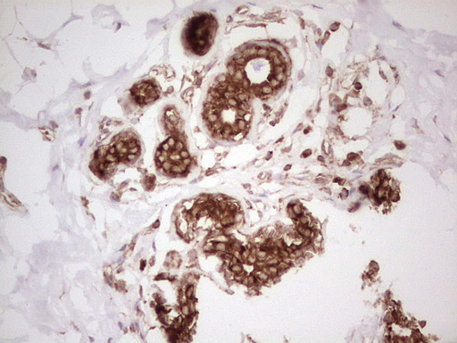 IHC of paraffin-embedded Adenocarcinoma of Human breast tissue using anti-WIBG mouse monoclonal antibody. (Heat-induced epitope retrieval by 1 mM EDTA in 10mM Tris, pH8.5, 120°C for 3min).