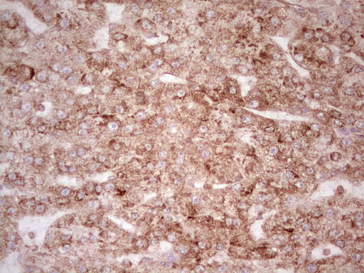 IHC of paraffin-embedded Carcinoma of Human liver tissue using anti-WIBG mouse monoclonal antibody. (Heat-induced epitope retrieval by 1 mM EDTA in 10mM Tris, pH8.5, 120°C for 3min).