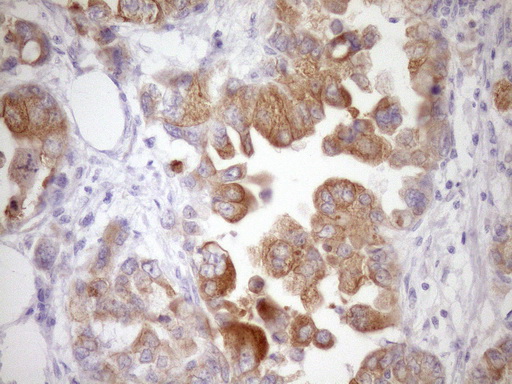 IHC of paraffin-embedded Adenocarcinoma of Human endometrium tissue using anti-WIBG mouse monoclonal antibody. (Heat-induced epitope retrieval by Tris-EDTA, pH8.0)(1:150).