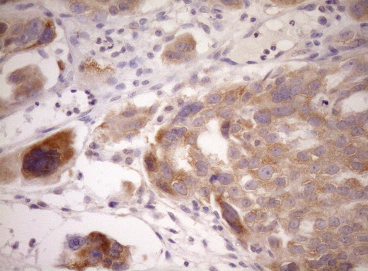 IHC of paraffin-embedded Adenocarcinoma of Human ovary tissue using anti-WIBG mouse monoclonal antibody. (Heat-induced epitope retrieval by Tris-EDTA, pH8.0)(1:150).