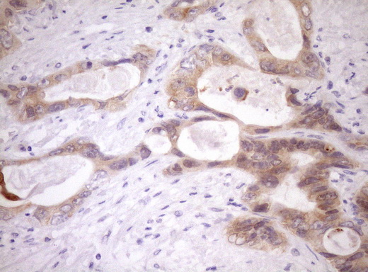 IHC of paraffin-embedded Adenocarcinoma of Human colon tissue using anti-WIBG mouse monoclonal antibody. (Heat-induced epitope retrieval by Tris-EDTA, pH8.0)(1:150).