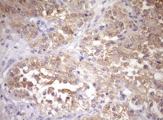 IHC of paraffin-embedded Carcinoma of Human kidney tissue using anti-WIBG mouse monoclonal antibody. (Heat-induced epitope retrieval by Tris-EDTA, pH8.0)(1:150).