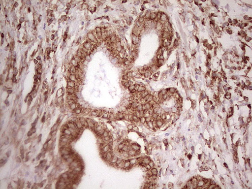 IHC of paraffin-embedded Carcinoma of Human pancreas tissue using anti-WIBG mouse monoclonal antibody. (Heat-induced epitope retrieval by 1 mM EDTA in 10mM Tris, pH8.5, 120°C for 3min).