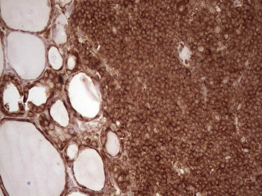 IHC of paraffin-embedded Human thyroid tissue using anti-WIBG mouse monoclonal antibody. (Heat-induced epitope retrieval by 1 mM EDTA in 10mM Tris, pH8.5, 120°C for 3min).