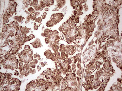 IHC of paraffin-embedded Adenocarcinoma of Human ovary tissue using anti-WIBG mouse monoclonal antibody. (Heat-induced epitope retrieval by 1 mM EDTA in 10mM Tris, pH8.5, 120°C for 3min).