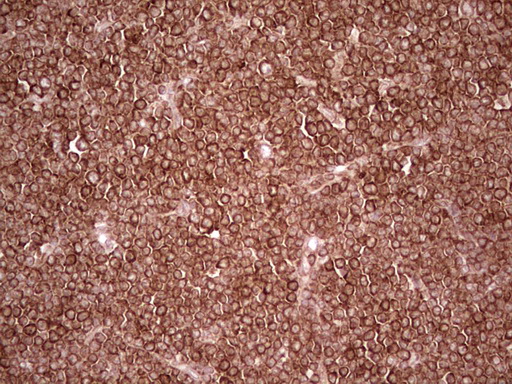 IHC of paraffin-embedded Human lymphoma tissue using anti-WIBG mouse monoclonal antibody. (Heat-induced epitope retrieval by 1 mM EDTA in 10mM Tris, pH8.5, 120°C for 3min).