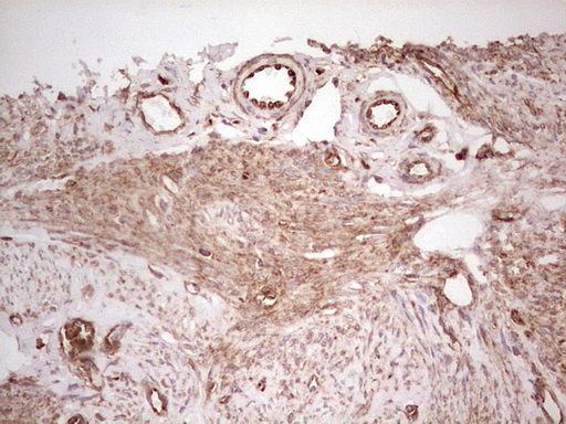IHC of paraffin-embedded Adenocarcinoma of Human endometrium tissue using anti-WIBG mouse monoclonal antibody. (Heat-induced epitope retrieval by 1 mM EDTA in 10mM Tris, pH8.5, 120°C for 3min).