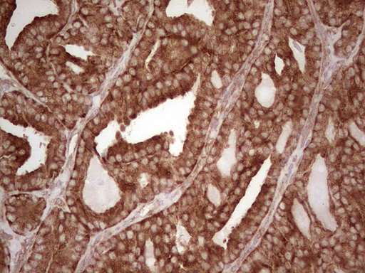 IHC of paraffin-embedded Carcinoma of Human thyroid tissue using anti-WIBG mouse monoclonal antibody. (Heat-induced epitope retrieval by 1 mM EDTA in 10mM Tris, pH8.5, 120°C for 3min).