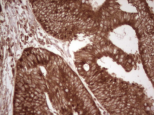 IHC of paraffin-embedded Adenocarcinoma of Human colon tissue using anti-WIBG mouse monoclonal antibody. (Heat-induced epitope retrieval by 1 mM EDTA in 10mM Tris, pH8.5, 120°C for 3min).