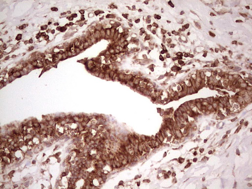 IHC of paraffin-embedded Adenocarcinoma of Human breast tissue using anti-WIBG mouse monoclonal antibody. (Heat-induced epitope retrieval by 1 mM EDTA in 10mM Tris, pH8.5, 120°C for 3min).