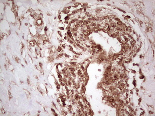 IHC of paraffin-embedded Carcinoma of Human lung tissue using anti-WIBG mouse monoclonal antibody. (Heat-induced epitope retrieval by 1 mM EDTA in 10mM Tris, pH8.5, 120°C for 3min).