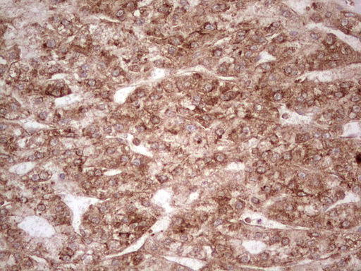 IHC of paraffin-embedded Carcinoma of Human liver tissue using anti-WIBG mouse monoclonal antibody. (Heat-induced epitope retrieval by 1 mM EDTA in 10mM Tris, pH8.5, 120°C for 3min).
