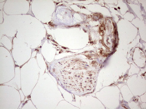 IHC of paraffin-embedded Carcinoma of Human kidney tissue using anti-WIBG mouse monoclonal antibody. (Heat-induced epitope retrieval by 1 mM EDTA in 10mM Tris, pH8.5, 120°C for 3min).