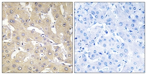 IHC of paraffin-embedded human liver carcinoma tissue, using TNAP2 Antibody. The picture on the right is treated with the synthesized peptide.