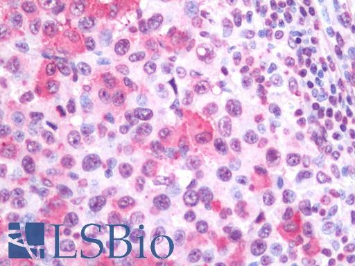 Human Melanoma (Lymph Node): Formalin-Fixed, Paraffin-Embedded (FFPE)