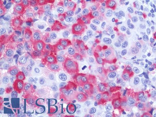 Human Melanoma (Lymph Node): Formalin-Fixed, Paraffin-Embedded (FFPE)