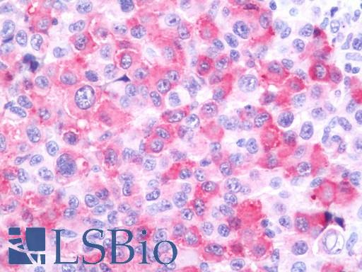 Human Melanoma (Lymph Node): Formalin-Fixed, Paraffin-Embedded (FFPE)