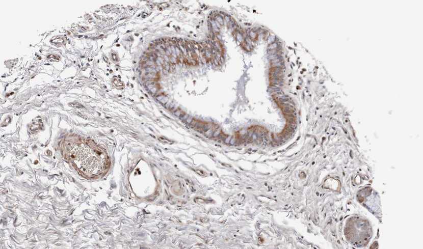 IHC of paraffin-embedded lung SCC xenograft using WNT11 antibody at 1:100 dilution.